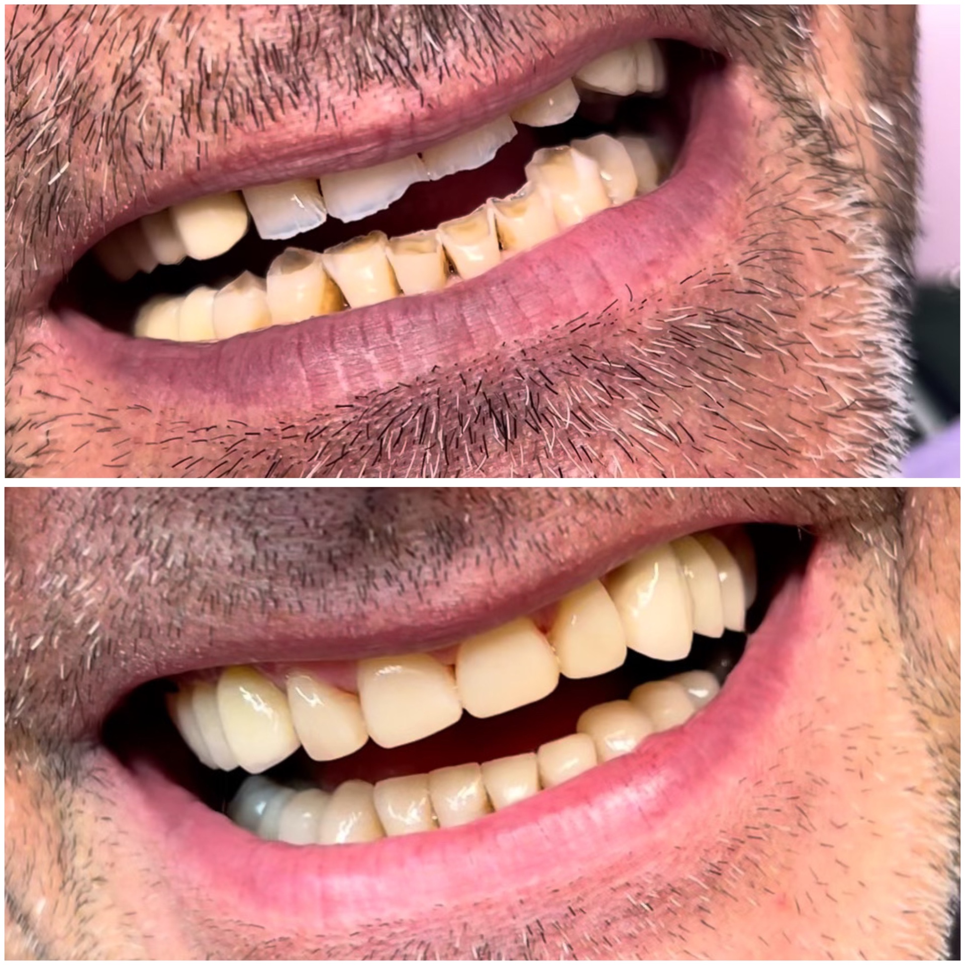 Injection technique