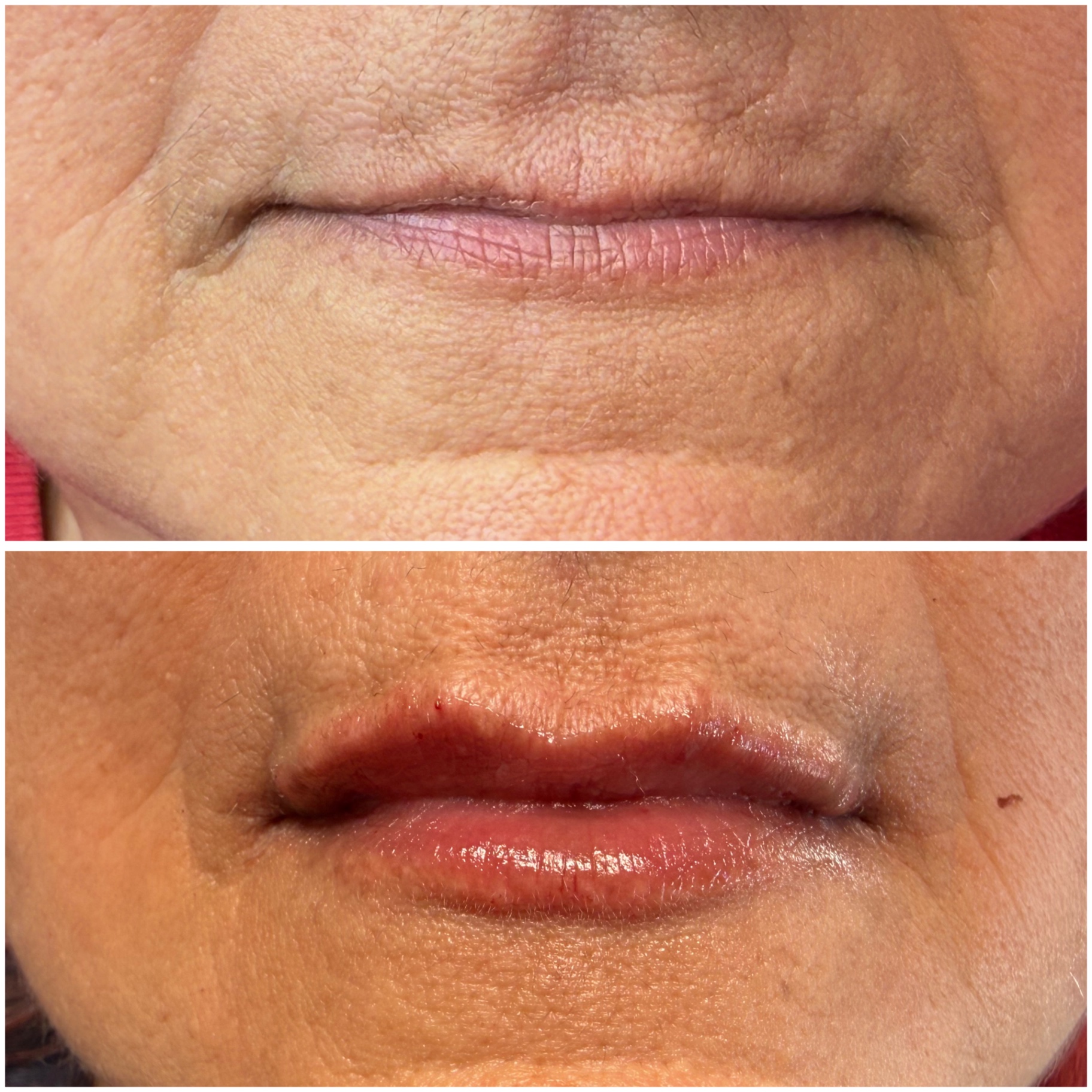 Filler labbra